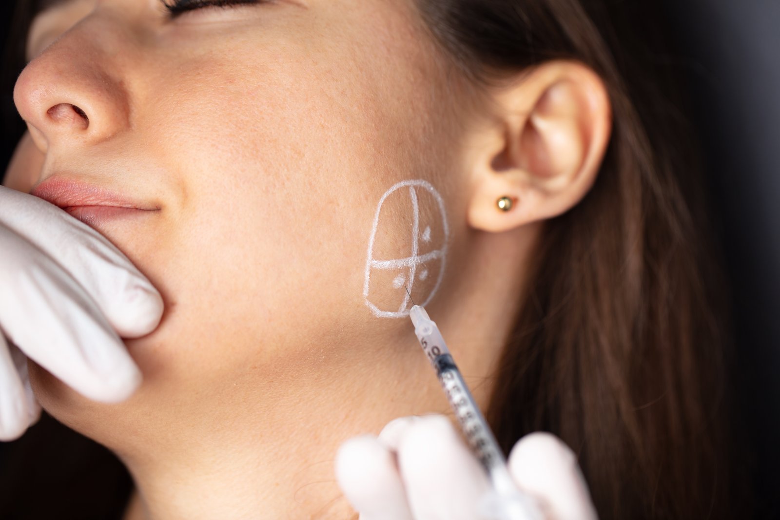 Botox injection being administered near the jaw for TMJ treatment